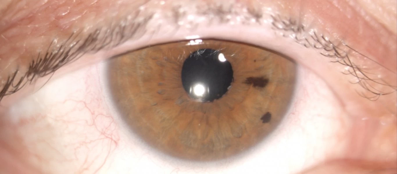 Ραγοειδίτιδα: Συμπτώματα και από τι προκαλείται